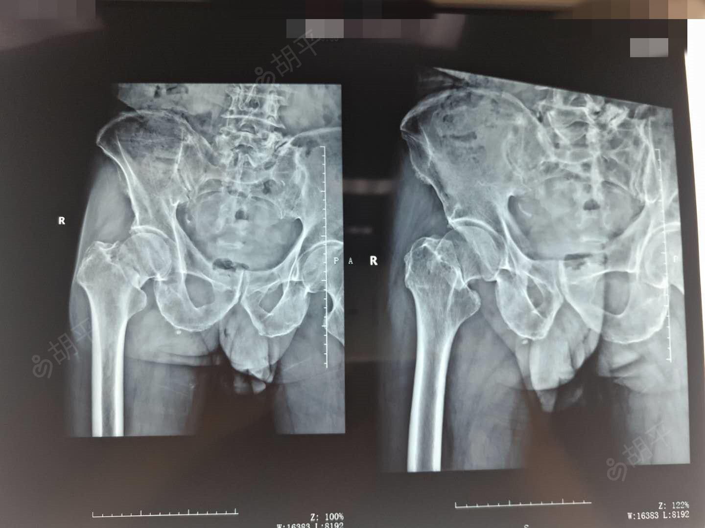 右股骨颈骨折人工股骨头置换术