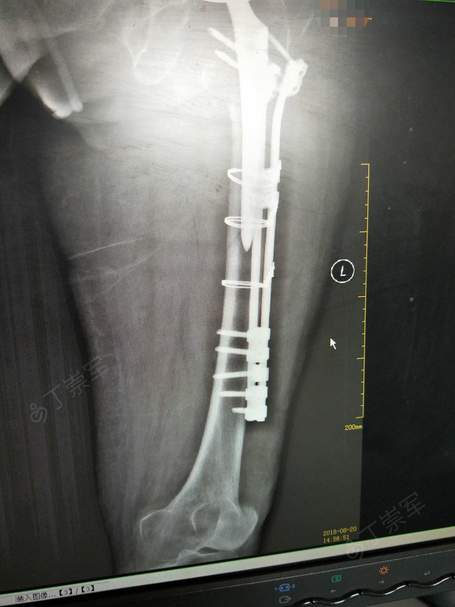 左侧人工股骨头置换术后假体周围骨折