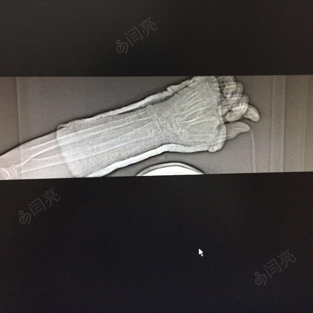 右腕部肿痛,出血