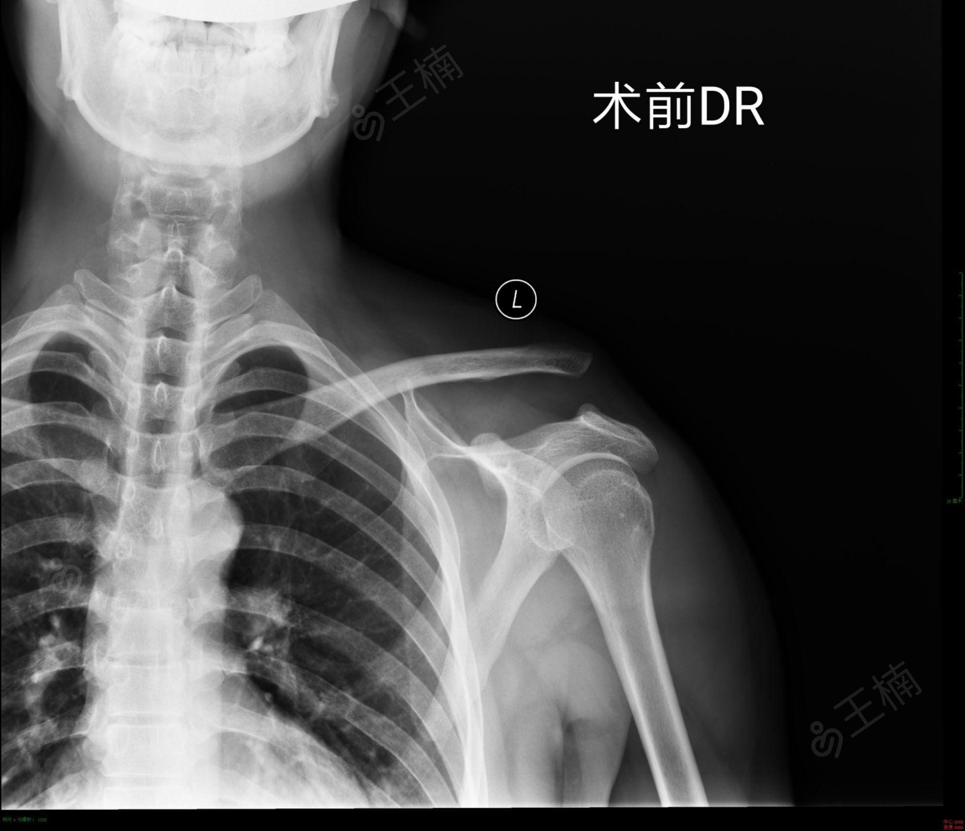 辅助检查 锁骨正轴位dr:左侧肩锁关节脱位,锁骨远端翘起,喙锁间隙