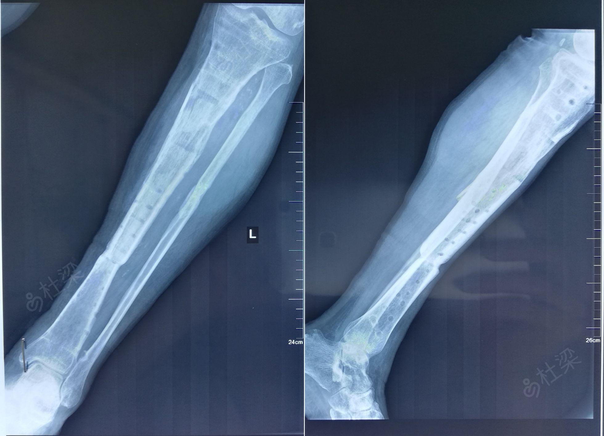 ilizarov技术治疗胫骨感染性骨不连