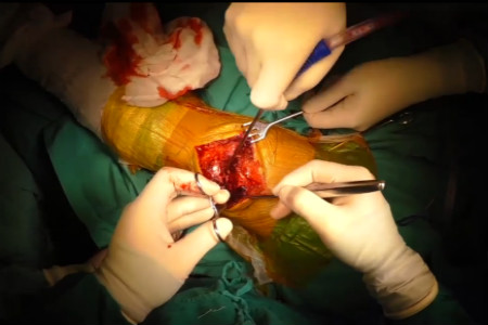 髌骨爪固定髌骨骨折