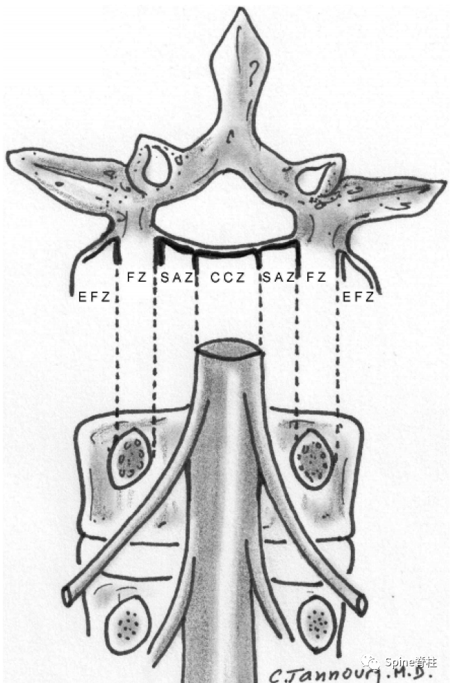 侧隐窝 (lateral recess)
