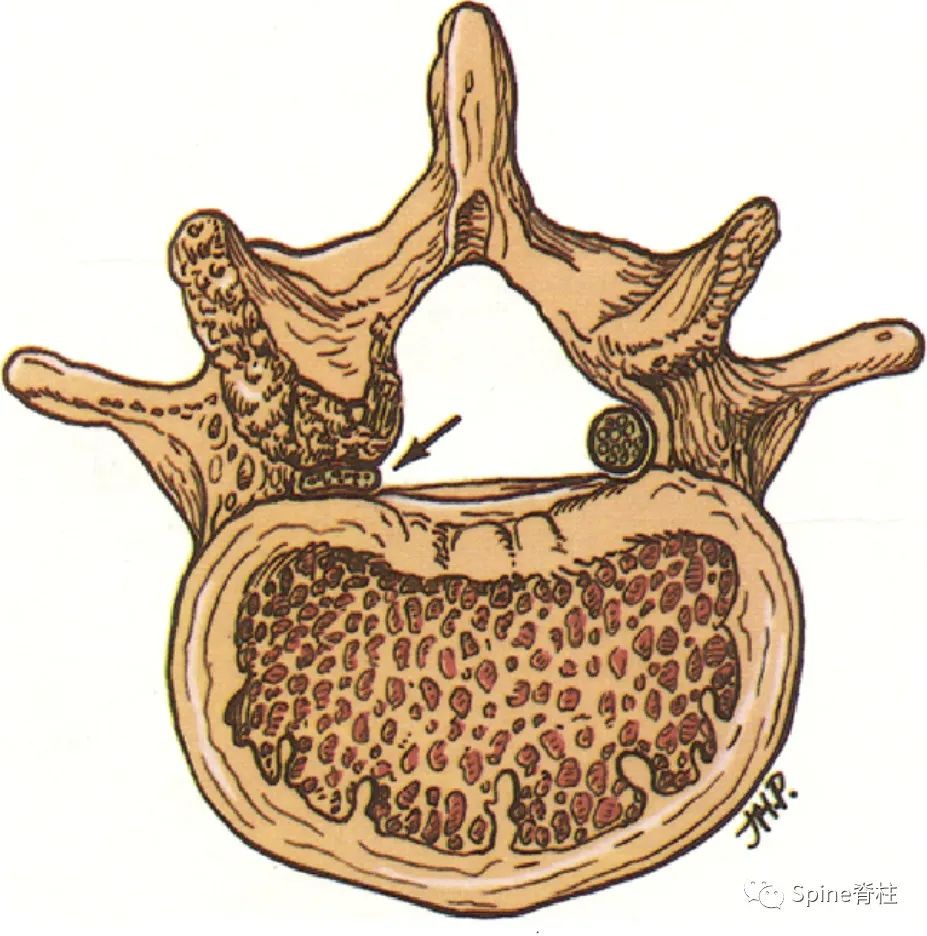 侧隐窝 (lateral recess)
