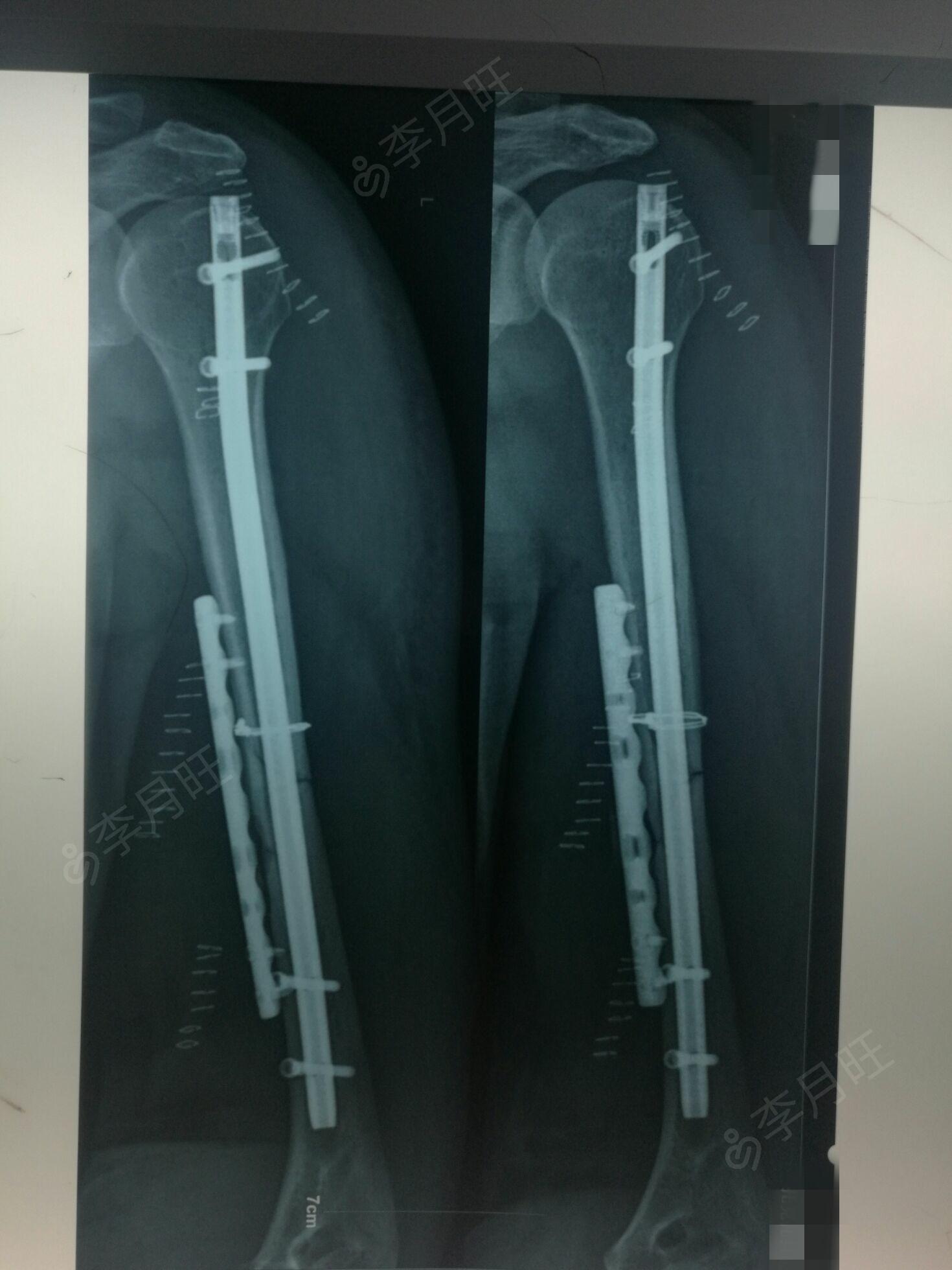 肱骨干粉碎骨折