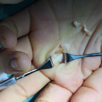 双手中指狭窄性腱鞘炎