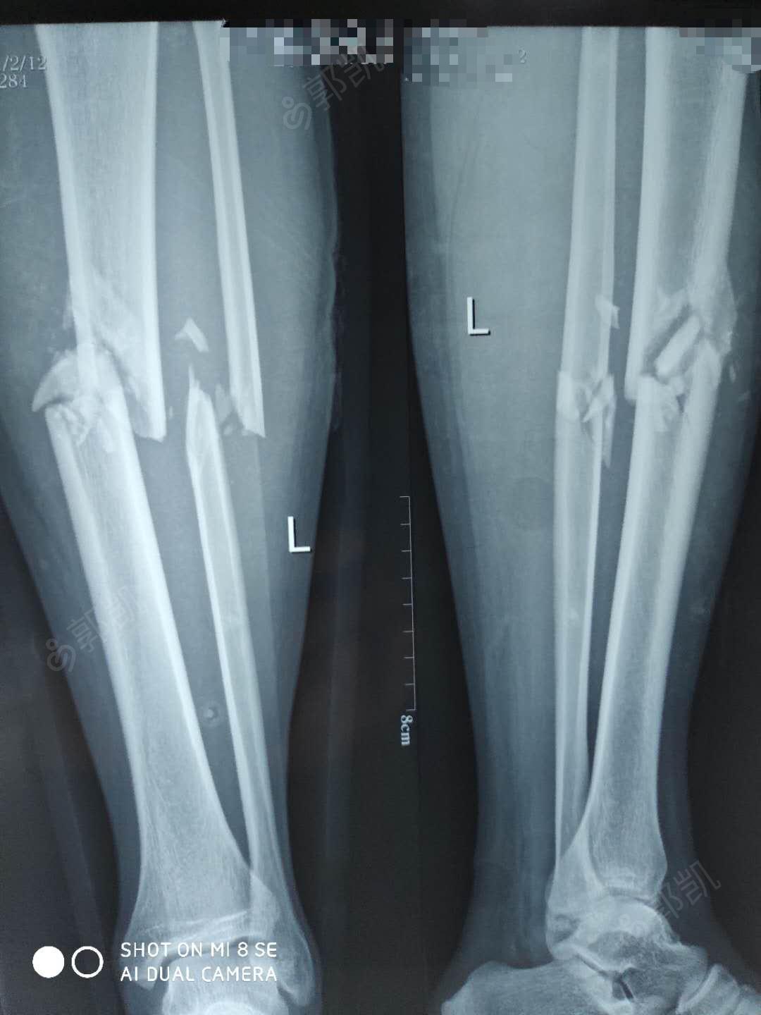 左胫腓骨骨折 2.多处软组织挫伤