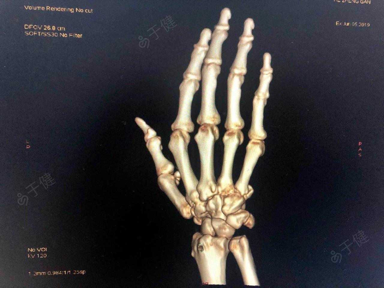 手掌骨骼结构图 x光片图片