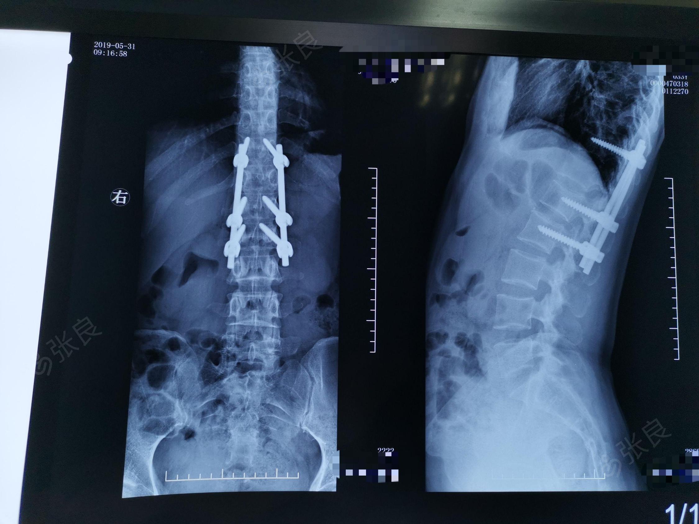 t12,l1骨折后路钉棒系统撑开复位内固定术