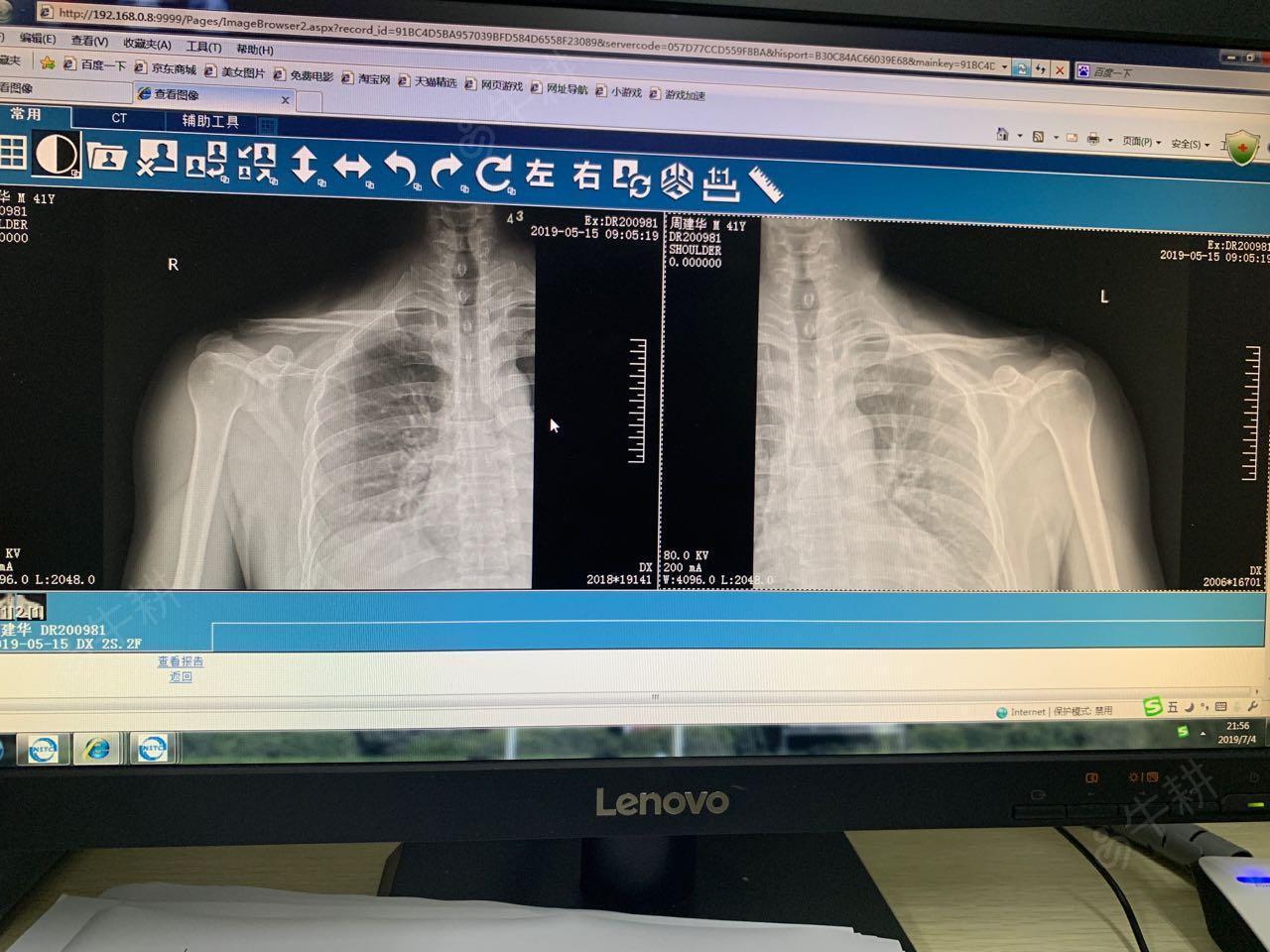 右锁骨骨折2.多处软组织挫擦伤