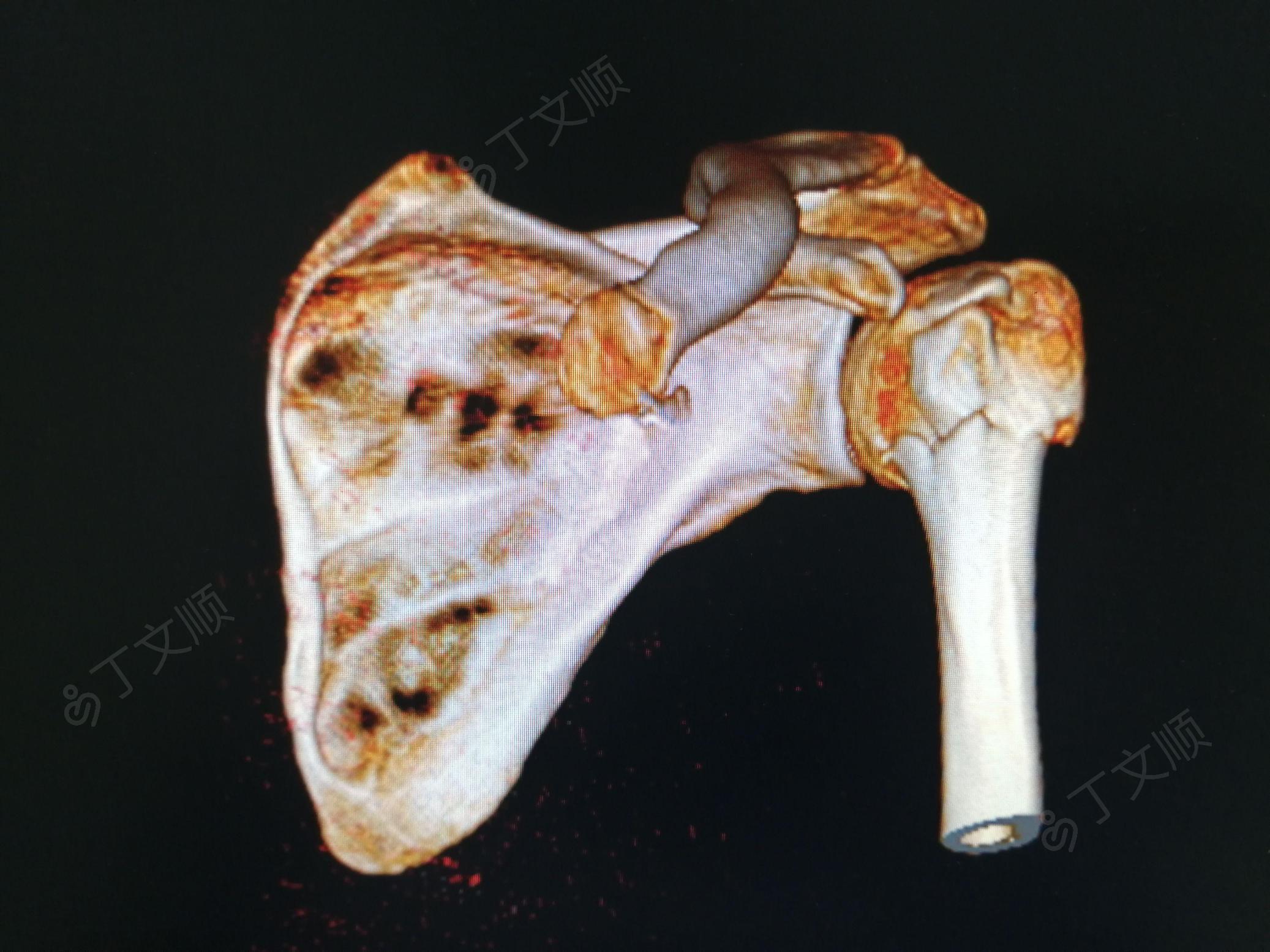 左侧肱骨外科颈骨折图图片