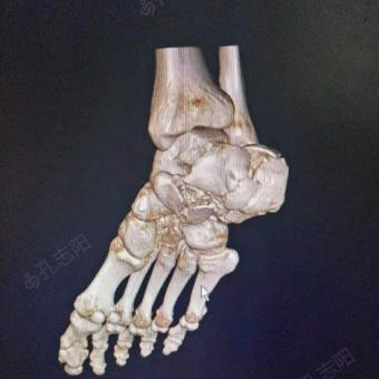 右跟骨粉碎性骨折