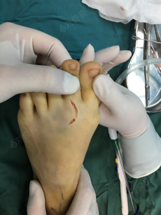 辅助检查 x线提示左足第2跖骨头坏死,部分关节面塌陷 诊断 freiberg病