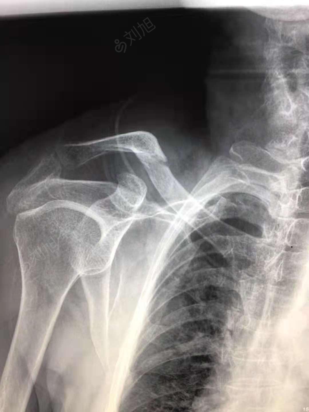 右锁骨骨折2,胸部软组织损伤