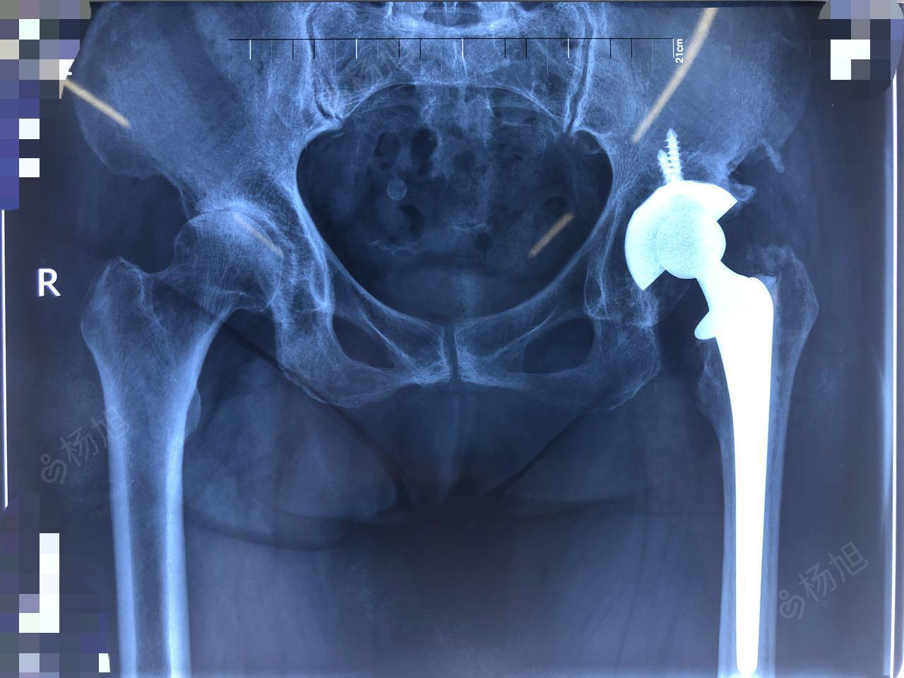 高龄股骨头缺血性坏死病例