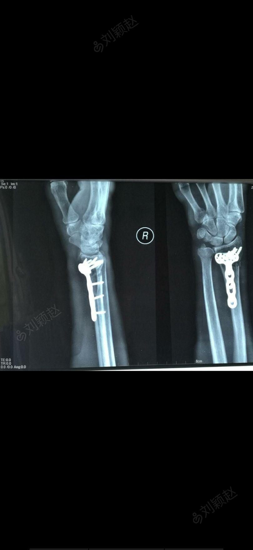 手术记录 1,右桡骨远端骨折切开复位内固定 改良掌侧做一长约6cm形