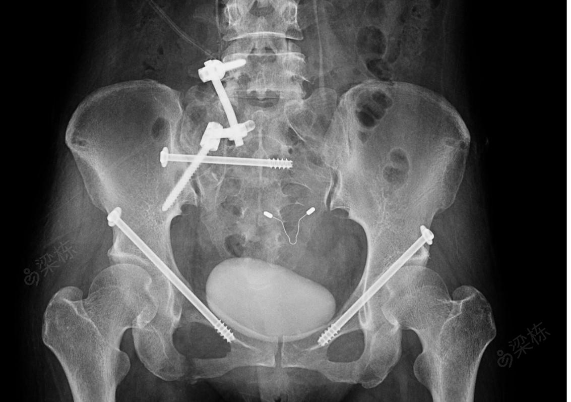 骨盆骨折闭合复位内固定术