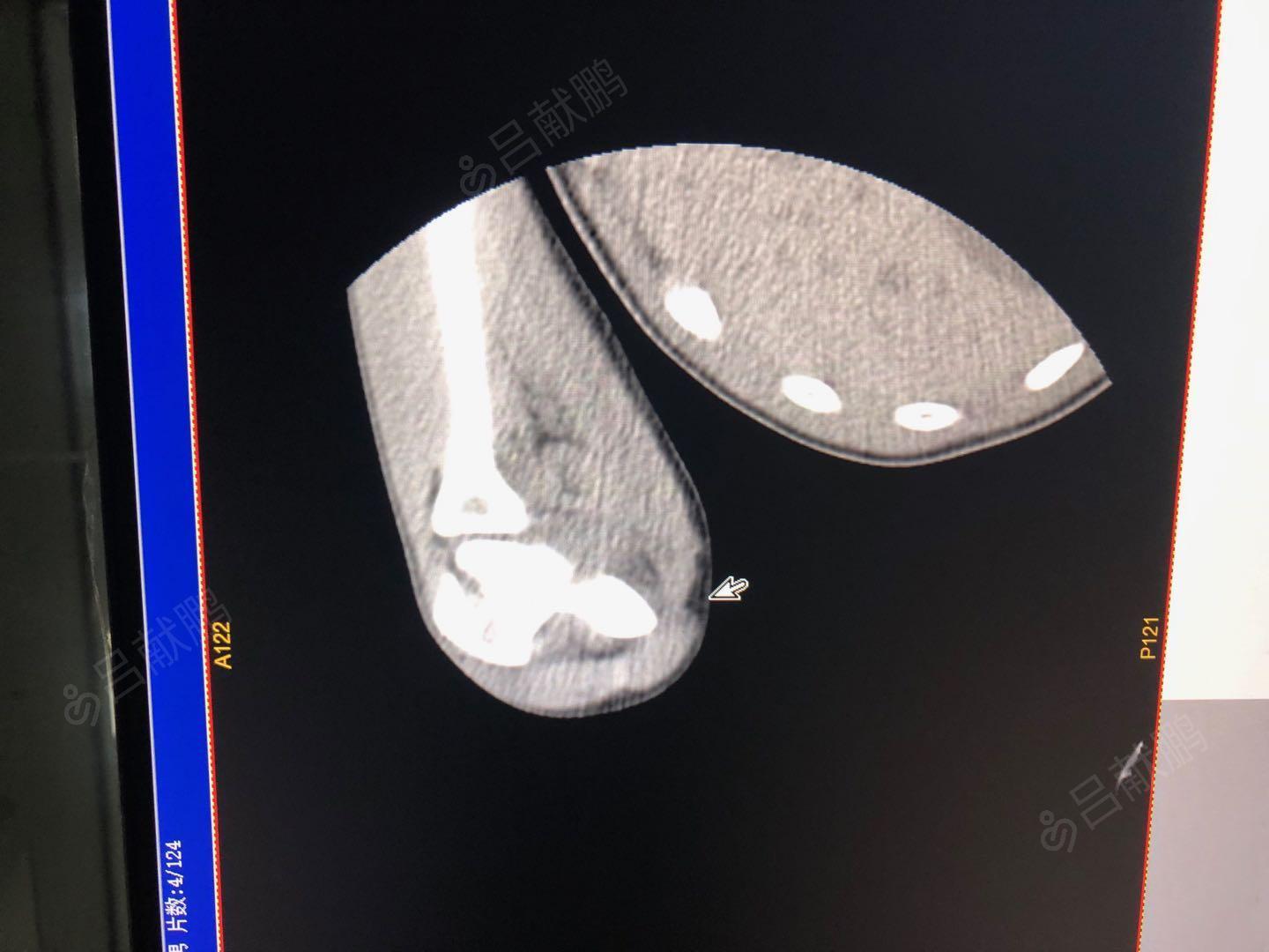 右肱骨小头骨折