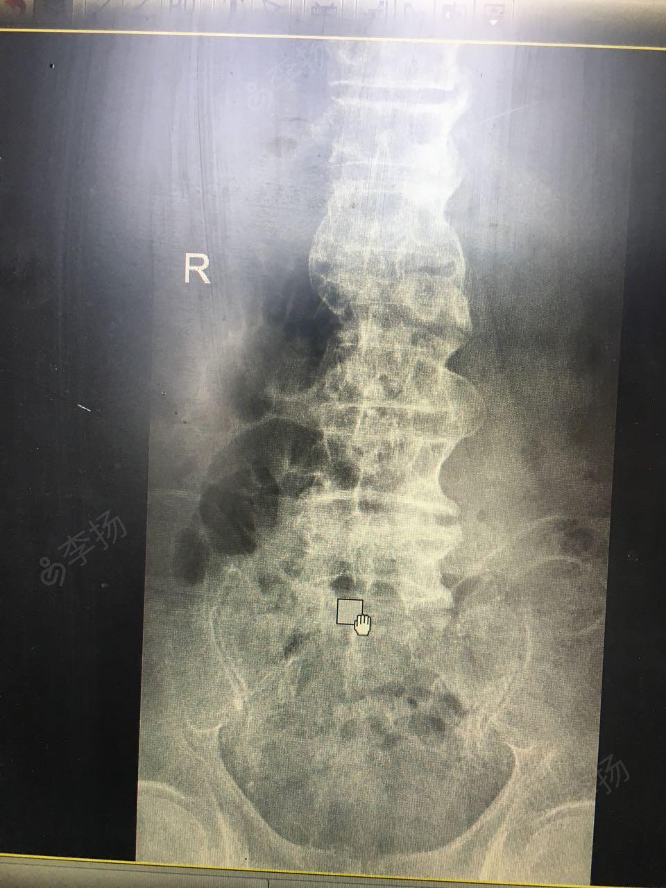腰椎间盘突出