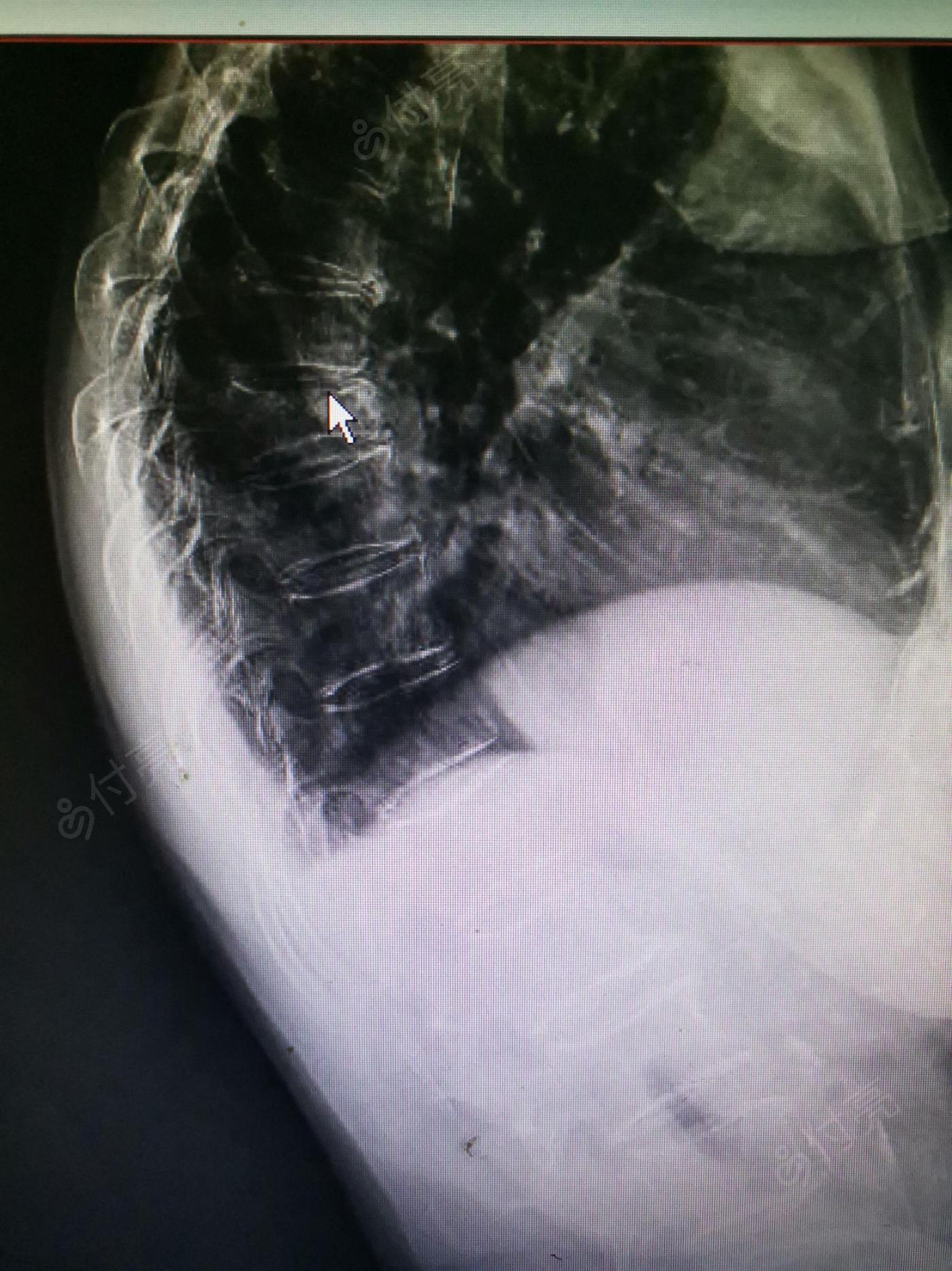 胸8椎体压缩性骨折