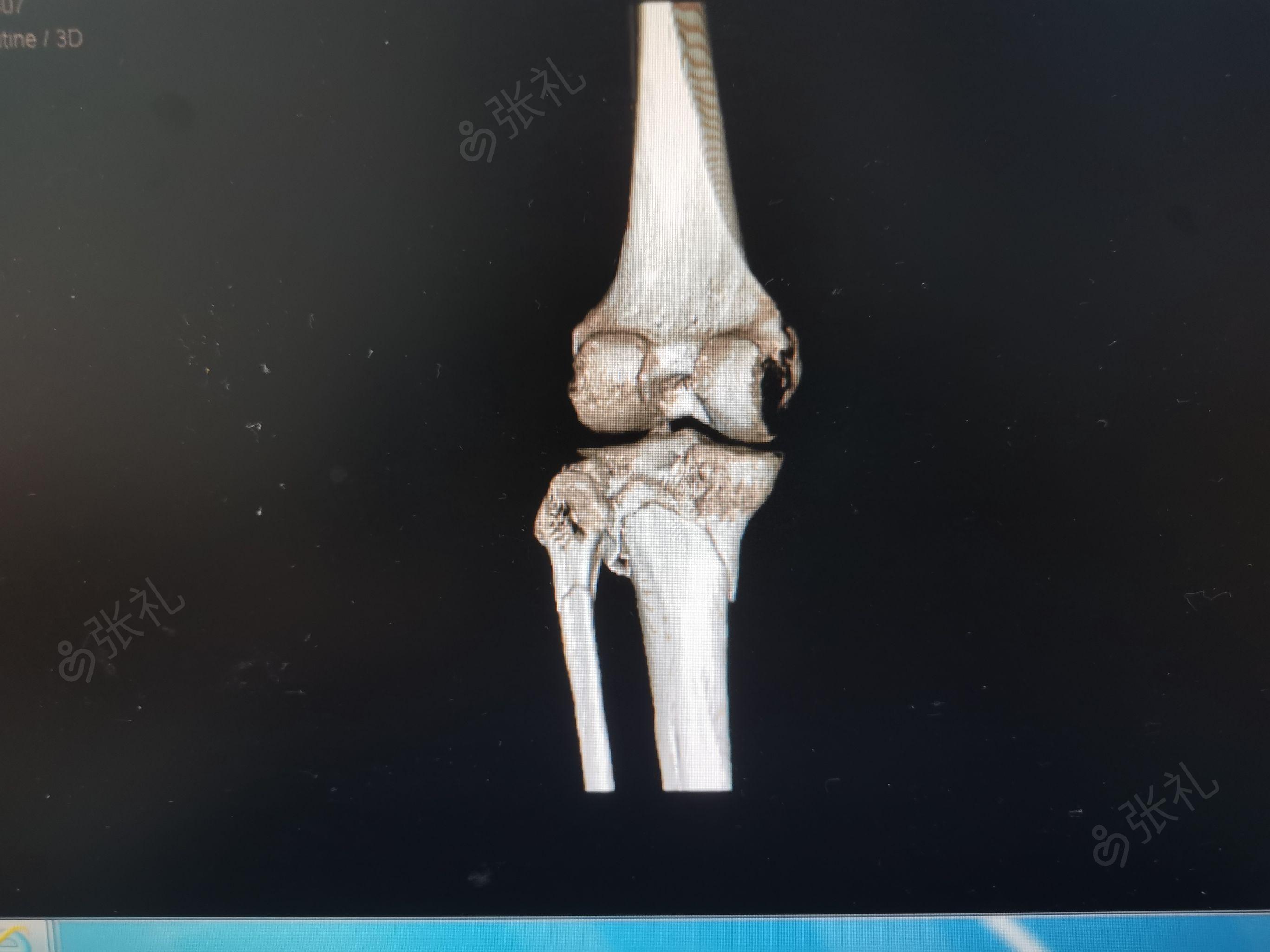 左胫骨平台骨折,左腓骨颈骨折一例