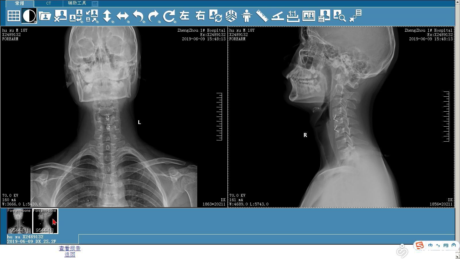 1例"平山病"病例汇报