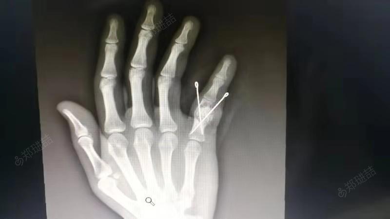 右手第5指近节指骨肿瘤