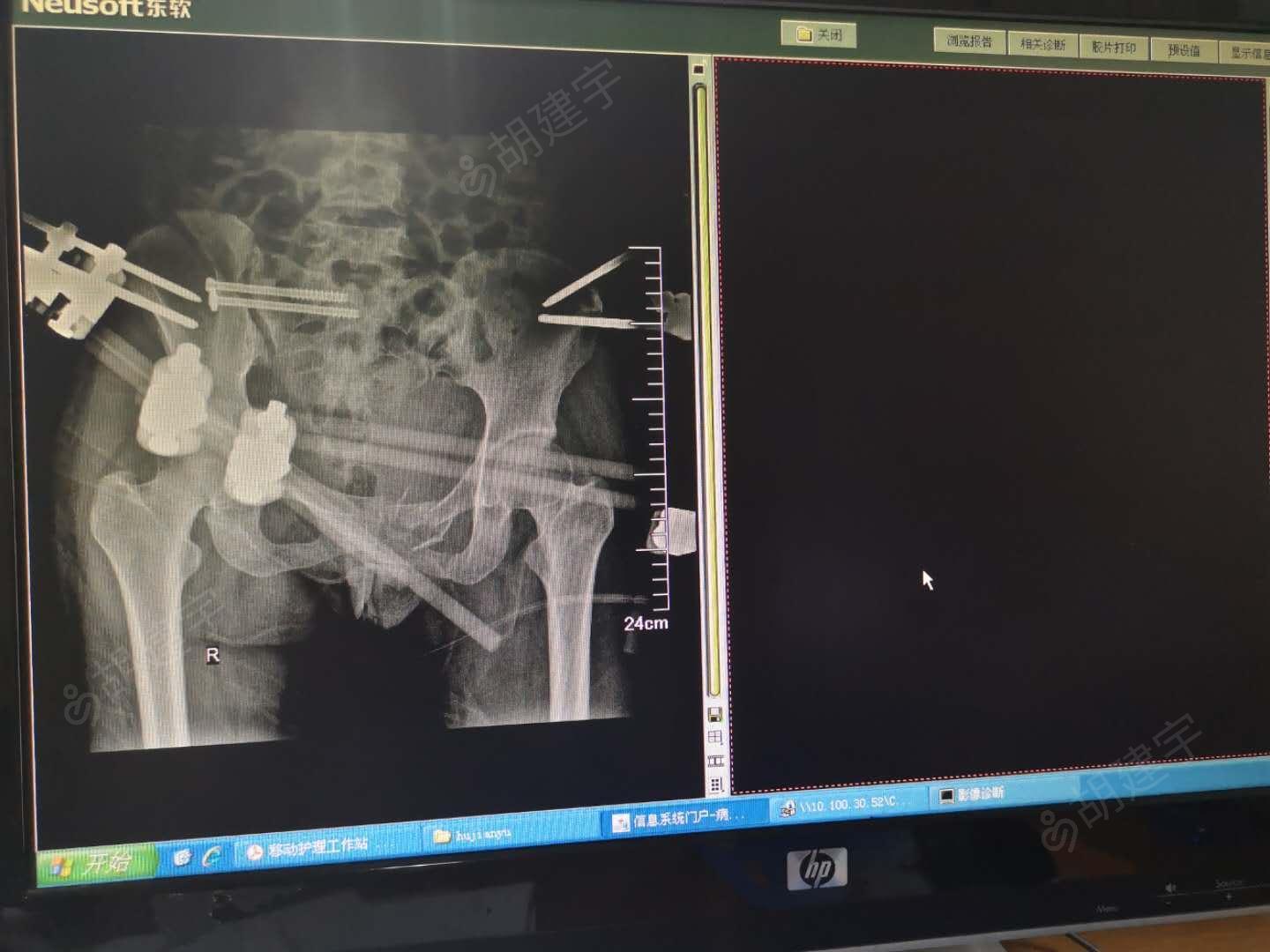 骨盆骨折闭合复位外固定架固定术