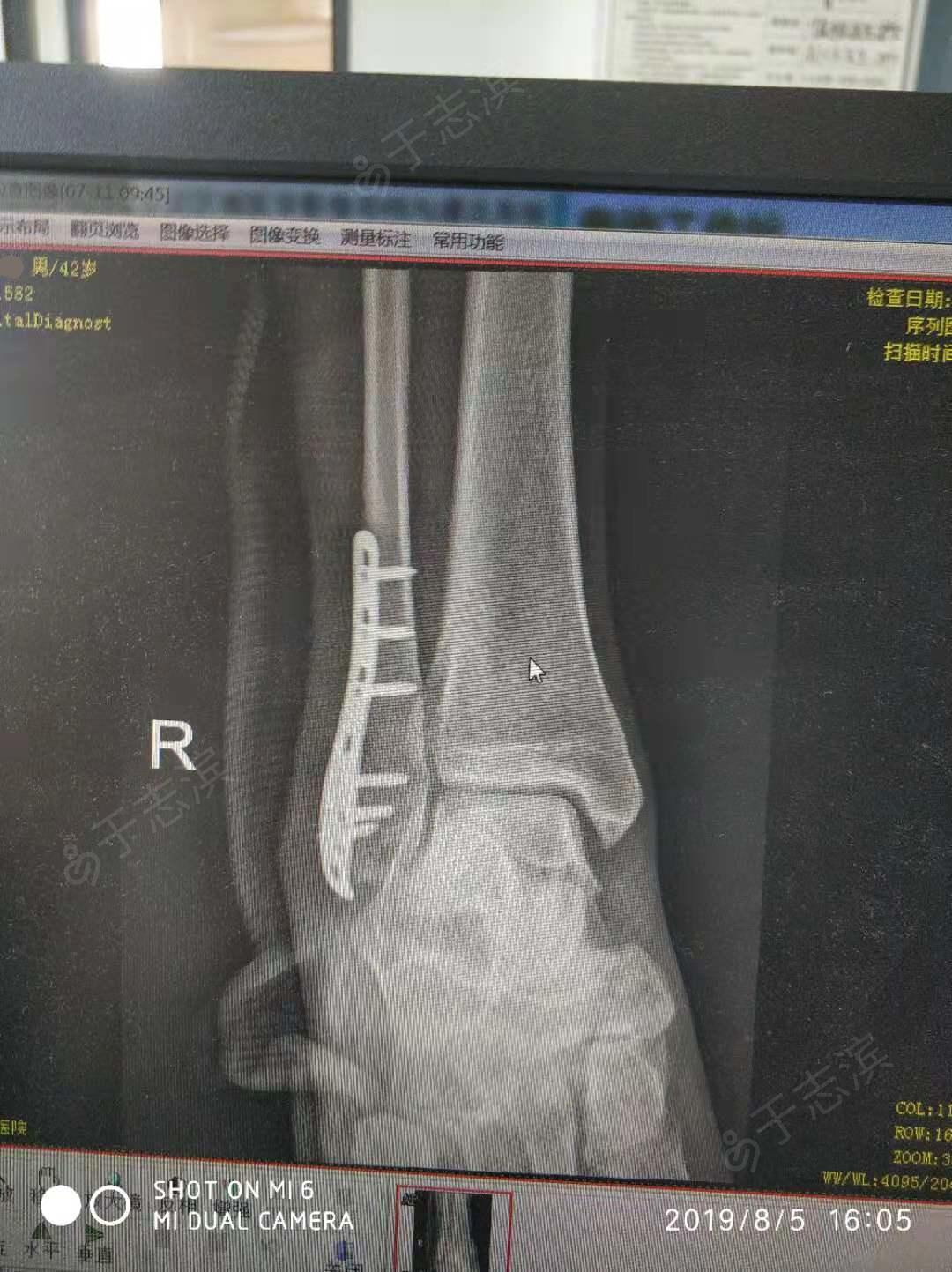 右外踝骨折切开复位内固定术