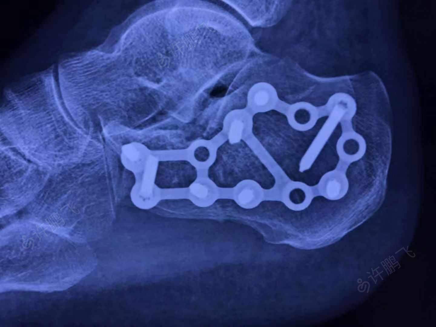 尺桡骨骨折手法复位 - 骨科与显微外科专业讨论版 - 爱爱医医学论坛