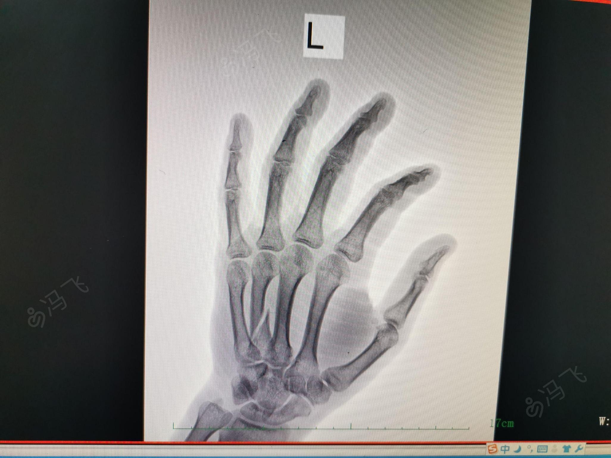 左手第四掌骨骨折图片图片