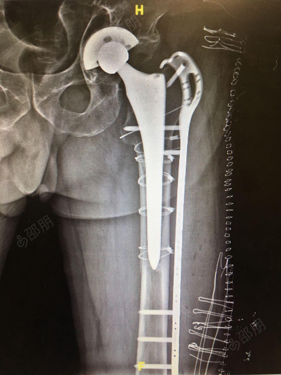 左股骨假体周围骨折