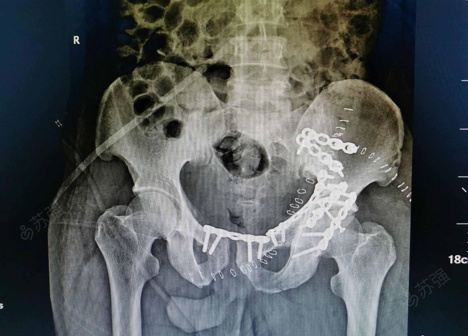 左侧髋臼骨折切开复位内固定术