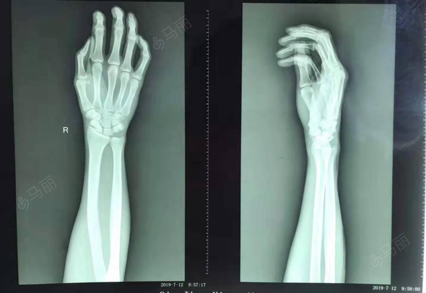 正常右手骨x光图片图片