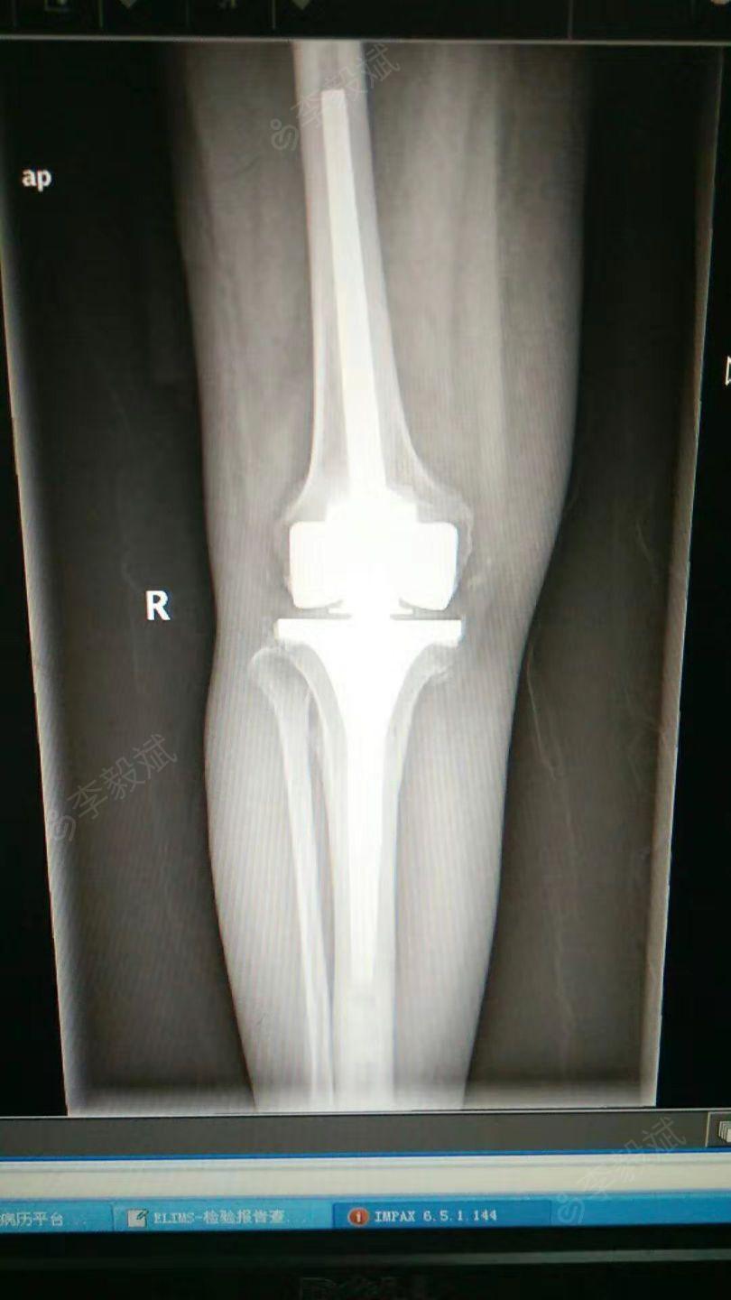 右膝胫骨平台骨折病例