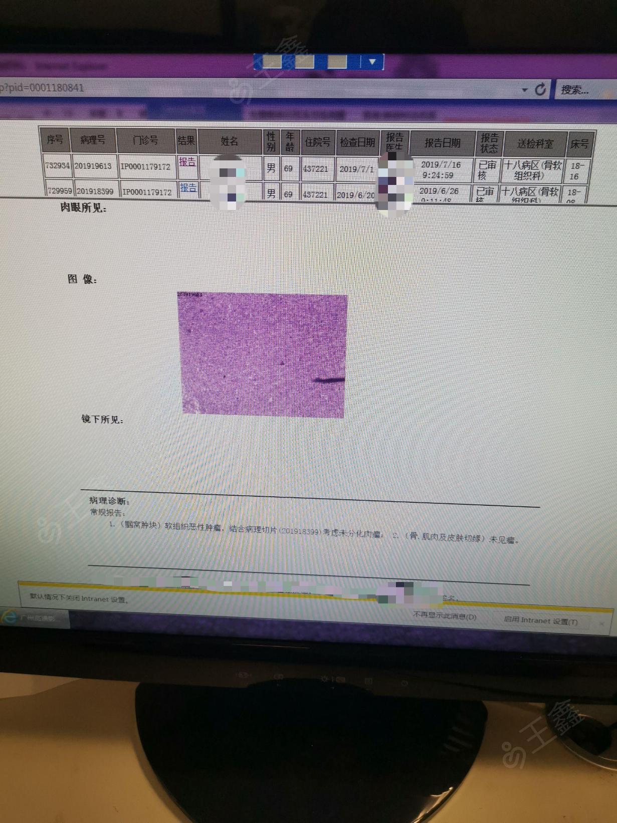 左腘窝多形性未分化肉瘤