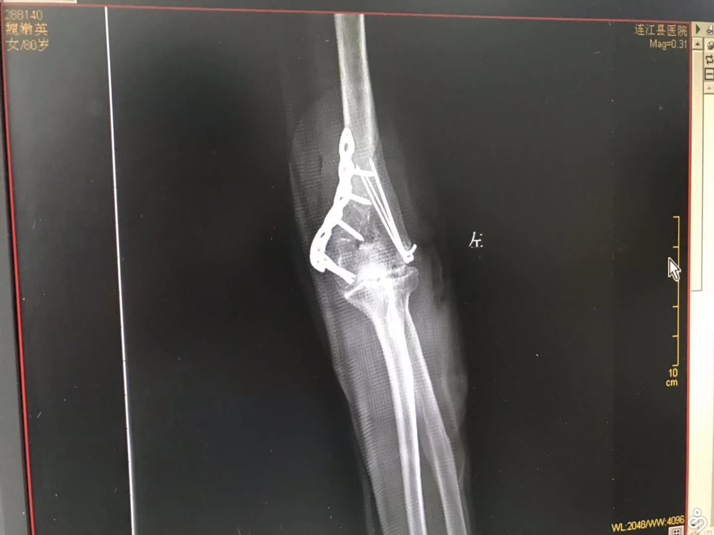 左肱骨髁上骨折