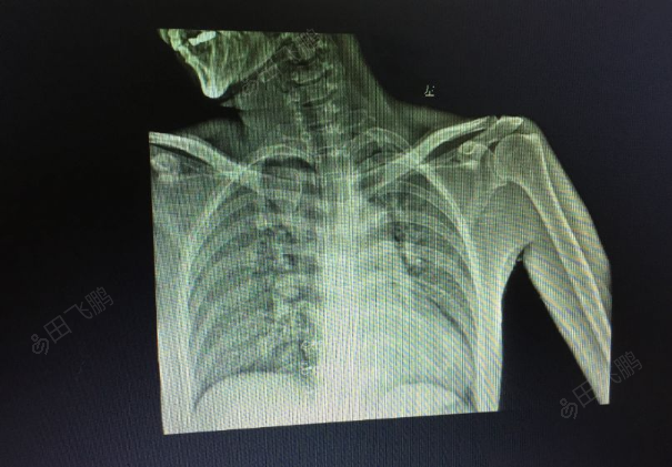肩胛骨侧位x线摆位图片