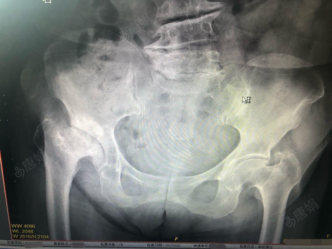 髋关节置换术后镇痛方案