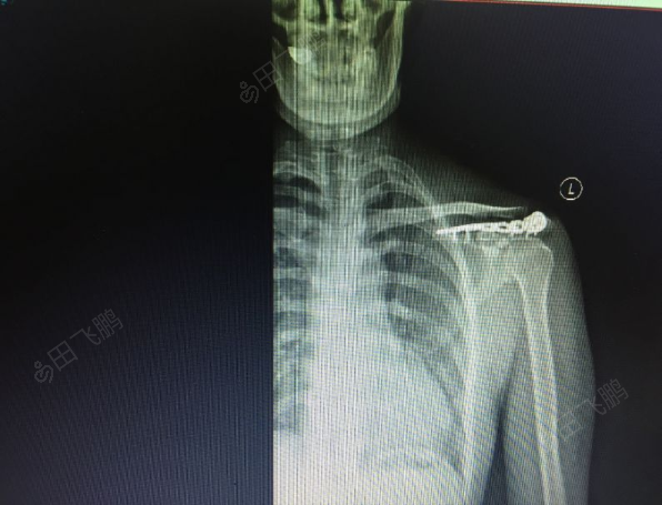 肩胛骨关节盂骨折图片