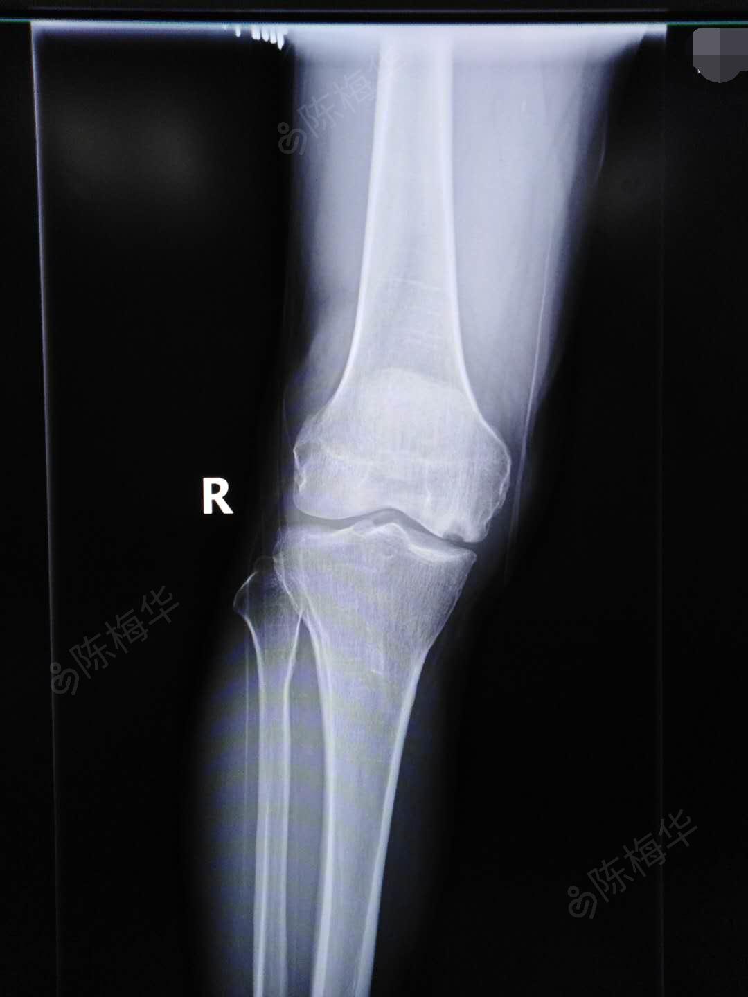 右胫骨内,外侧缘轻压痛,右膝关节被动活动正常,主动活动0度-110度,下