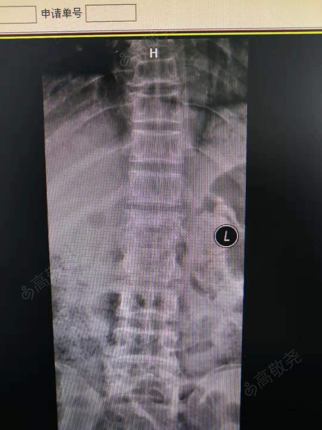 腰2椎體壓縮性骨折