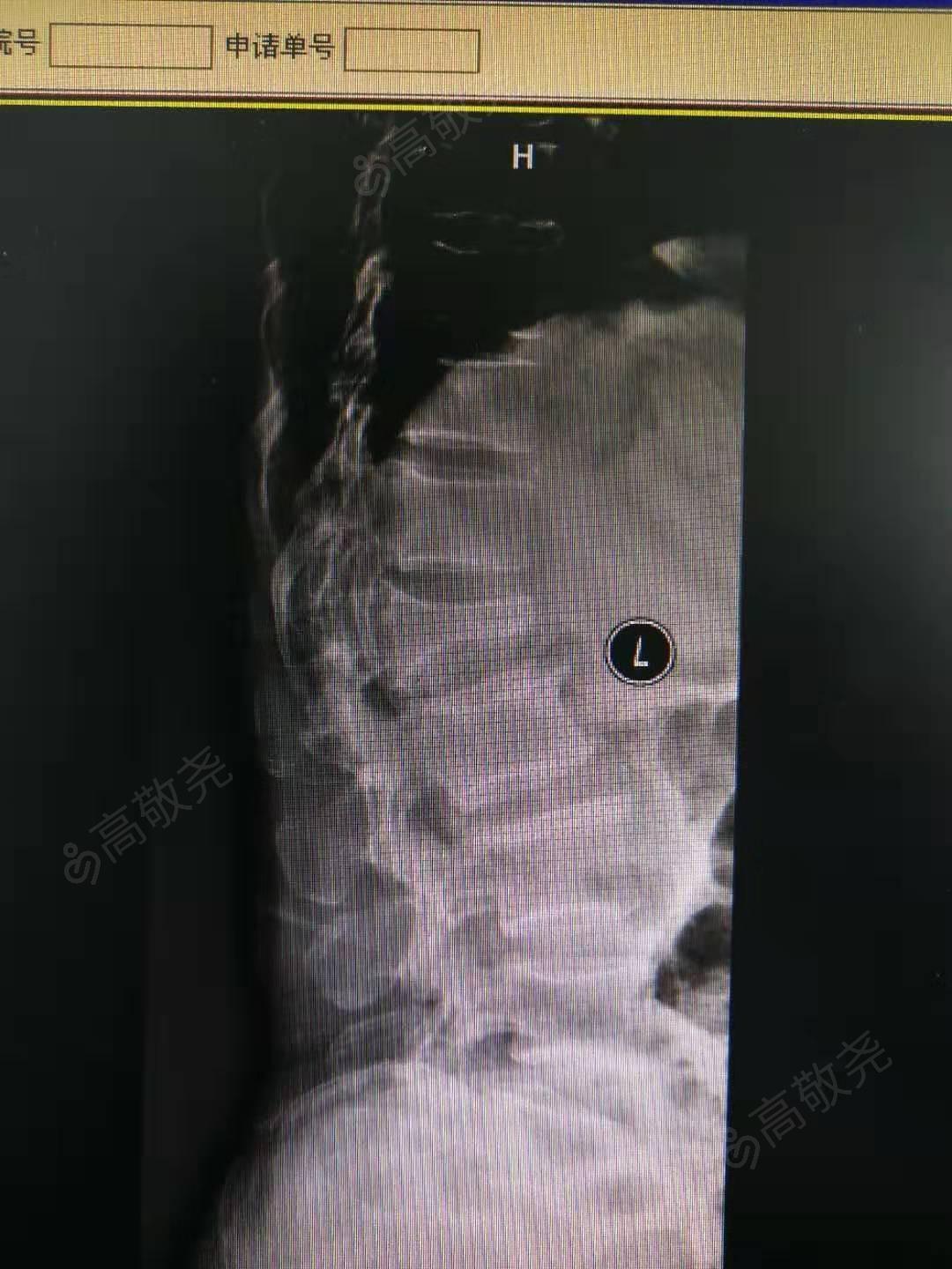 腰2椎體壓縮性骨折