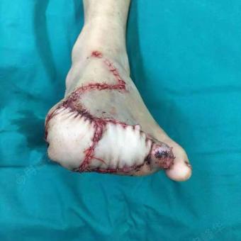 左足第1—4趾断趾再植术