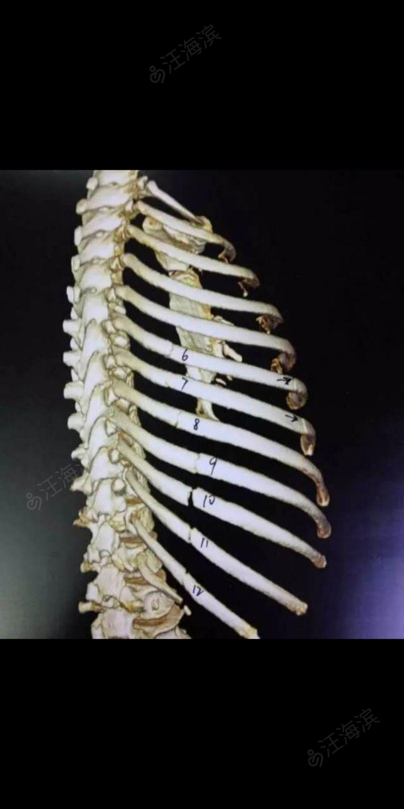 肋弓骨折图片