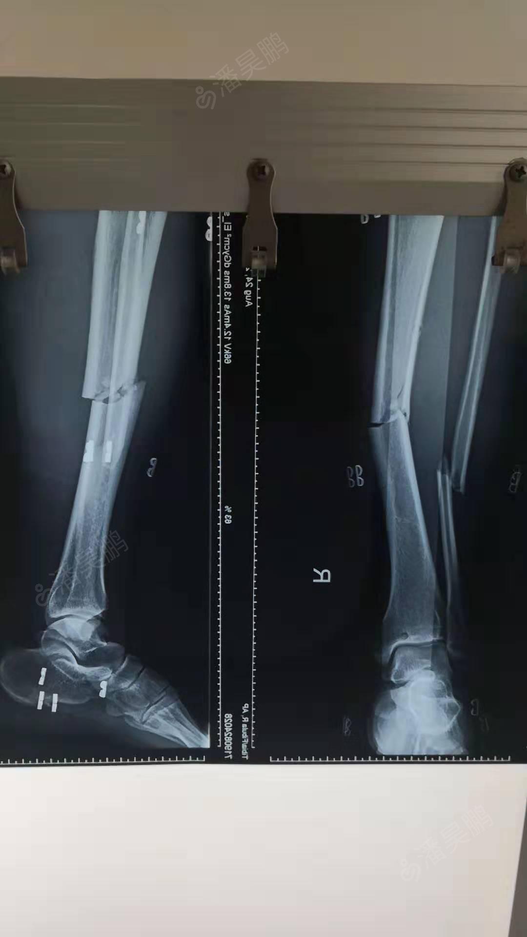 右腿右胫骨图片图片