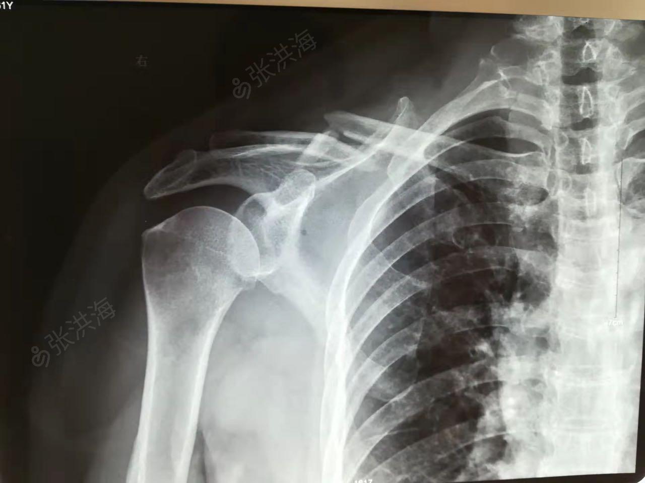 艾瑞昔布治疗锁骨骨折