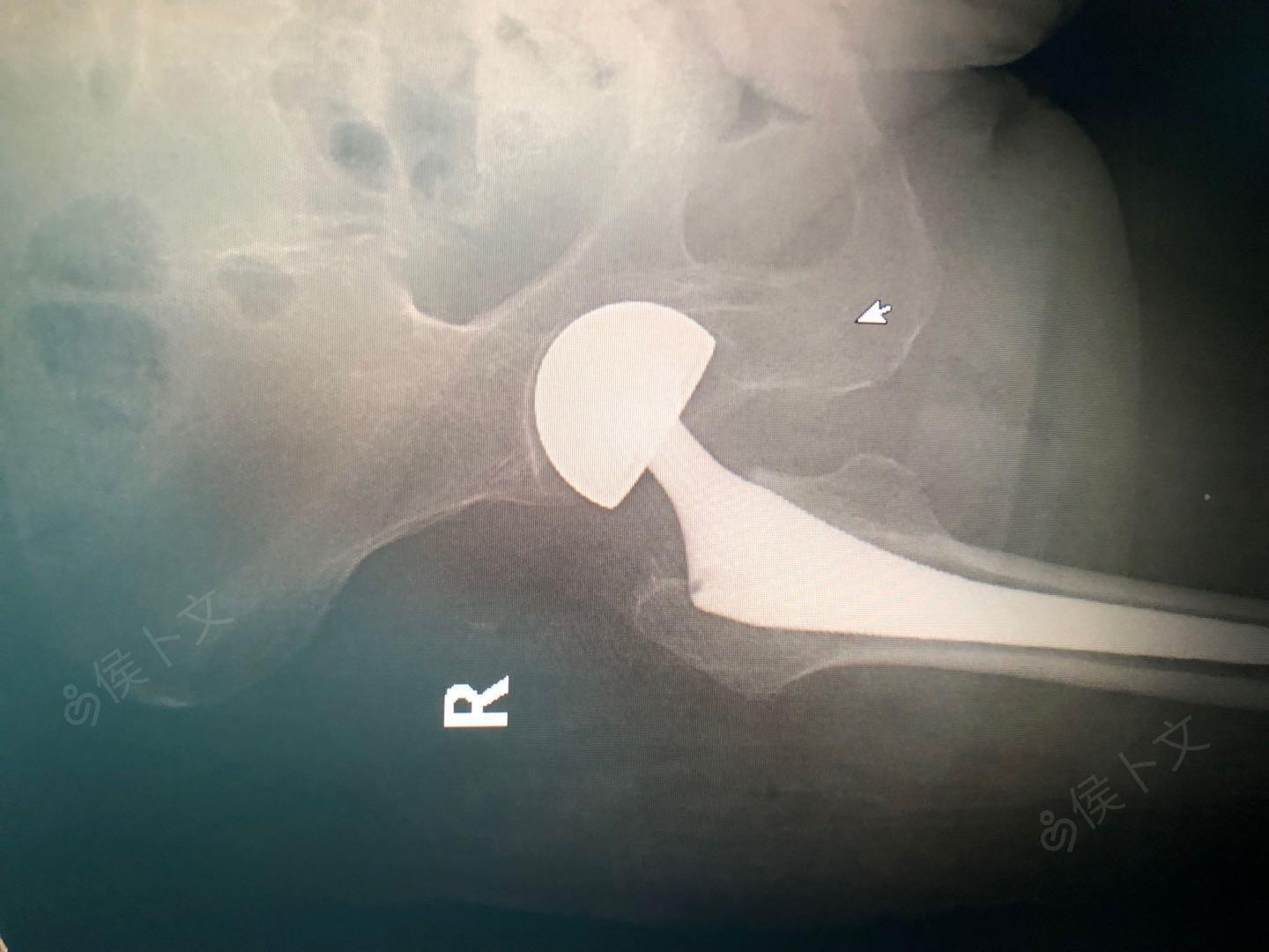 右侧股骨颈骨折