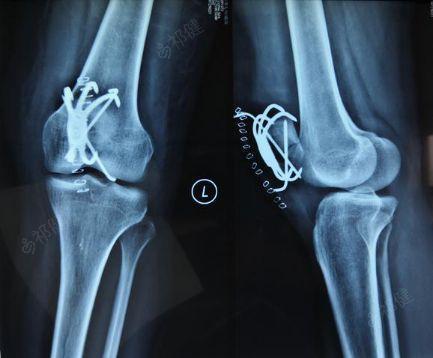 一例左侧膑骨骨折病例