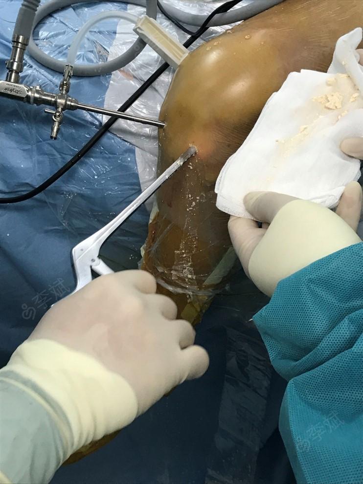 膝关节痛风性关节炎的关节镜治疗